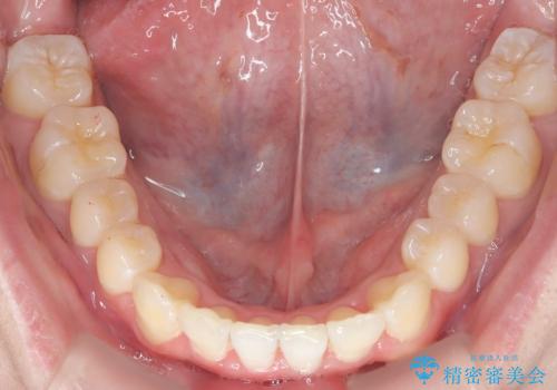 【インビザライン】前歯のガタガタ。非抜歯治療の治療後