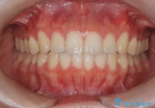 【インビザライン】前歯を下げたい