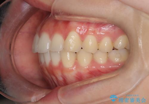 【インビザライン】前歯を下げたいの治療後