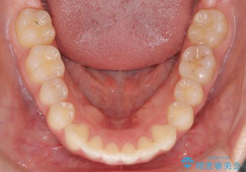 【インビザライン】前歯を下げたいの治療後