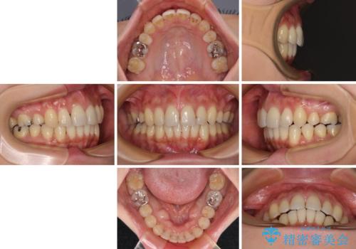 上顎前歯の突出を軽減 インビザラインによる抜歯矯正の治療後