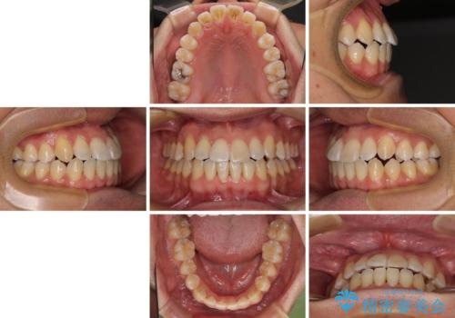 左右の八重歯が気になる ワイヤー装置での咬み合わせ改善の治療後