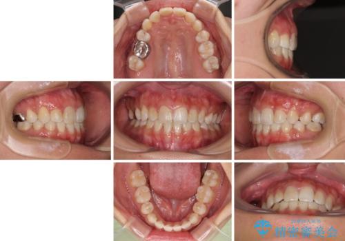 気になる八重歯 目立ちにくいハーフリンガルでの抜歯矯正の治療後