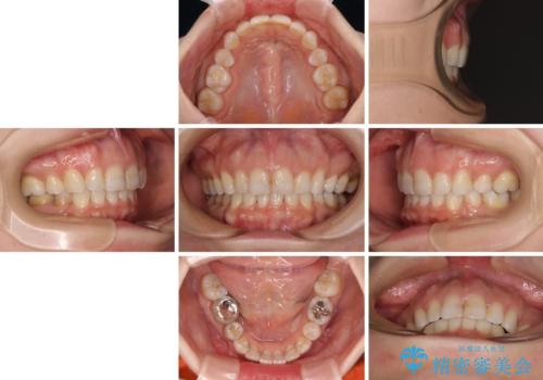 出っ歯と咬み合わせを改善 ワイヤー装置の抜歯矯正の治療後