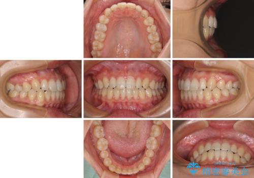 隙間だらけの歯列 インビザラインで改善の治療後