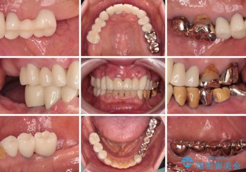 前歯をきれいにしたい インプラントや部分矯正を用いた総合歯科治療の治療後