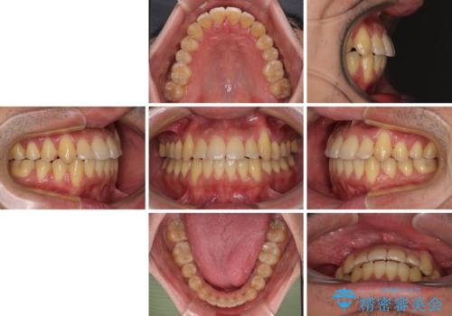 八重歯とクロスバイト 目立たないワイヤー装置で矯正治療の治療後
