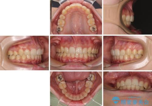 下顎前歯が隠れて突出した口元 ワイヤー装置での抜歯矯正の治療後