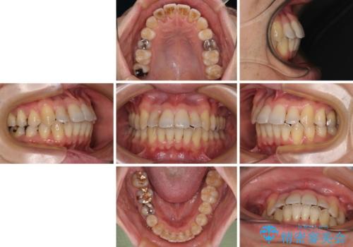前歯のクロスバイト　目立たないワイヤー装置で矯正治療の治療後