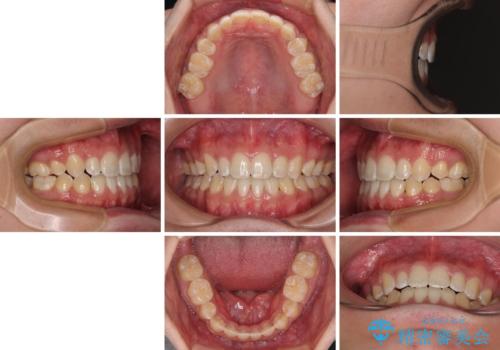 口元の突出感を改善 受け口傾向の咬み合わせの抜歯矯正の治療後