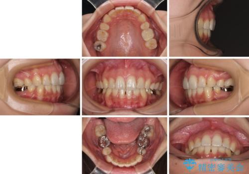 デコボコと口元の突出感 ハーフリンガルでの抜歯矯正の治療後