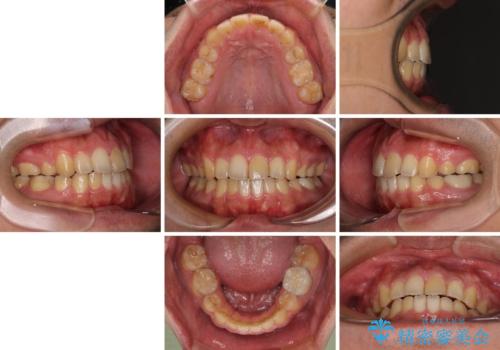 後戻りでデコボコの前歯 インビザライン矯正治療の治療後