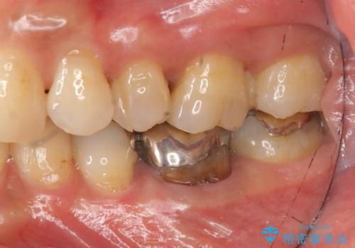 目立つ銀歯を白くしたいの治療前
