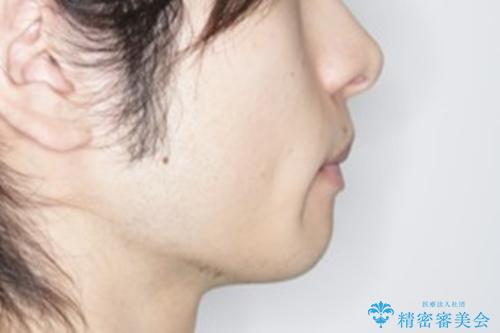 インビザライン:前歯のがたつきと噛み合わせの治療の治療前(顔貌)