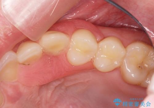 前歯に目立たないノンクラスプデンチャーを作りたいの治療後