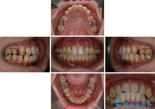 上顎前歯の突出を軽減 インビザラインによる抜歯矯正の治療中