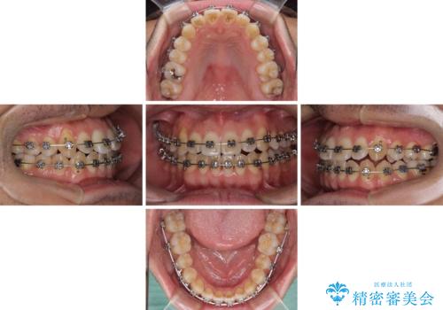 左右の八重歯が気になる ワイヤー装置での咬み合わせ改善の治療中