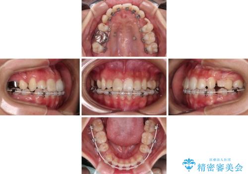 気になる八重歯 目立ちにくいハーフリンガルでの抜歯矯正の治療中