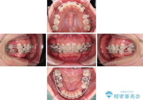 出っ歯と咬み合わせを改善 ワイヤー装置の抜歯矯正の治療中