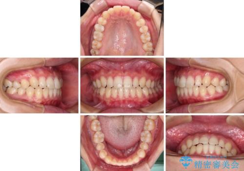 隙間だらけの歯列 インビザラインで改善の治療中