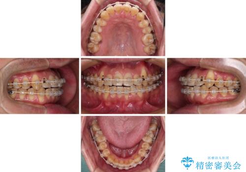 八重歯とクロスバイト 目立たないワイヤー装置で矯正治療の治療中