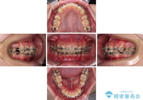 下顎前歯が隠れて突出した口元　ワイヤー装置での抜歯矯正の治療中