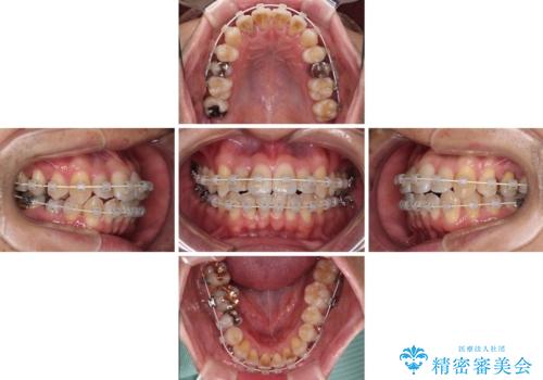 前歯のクロスバイト　目立たないワイヤー装置で矯正治療の治療中