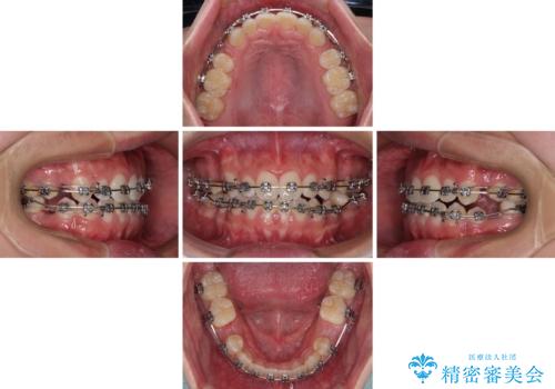 口元の突出感を改善 受け口傾向の咬み合わせの抜歯矯正の治療中