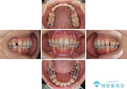 デコボコと口元の突出感 ハーフリンガルでの抜歯矯正の治療中