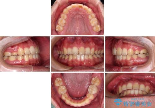 後戻りでデコボコの前歯 インビザライン矯正治療の治療中