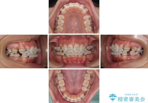 抜歯矯正で唇を閉じやすく 目立たないワイヤー装置の治療中