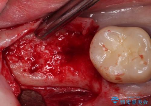 【インプラント】 他院で入れた被せ物が取れたの治療中