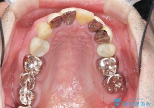 全ての歯を治療したいの治療前