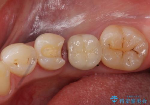 銀の詰め物 セラミックへのやり替えの治療中