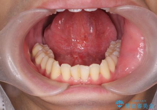 滑舌の改善をしたいの治療後