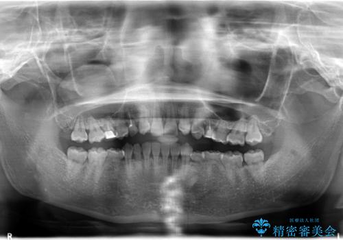 【総合歯科治療】インプラント+インビザラインの治療前
