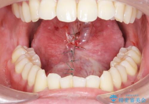 滑舌の改善をしたいの治療中