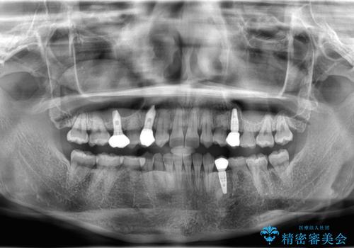 【総合歯科治療】インプラント+インビザラインの治療後