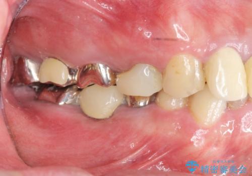 全ての歯を治療したいの治療前