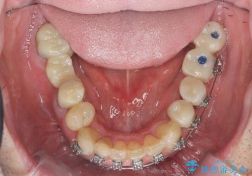 全ての歯を治療したいの治療中