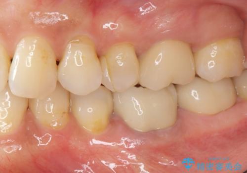 目立つ銀歯を白くしたいの治療後