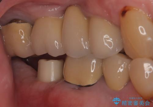 【インプラント】 他院で入れた被せ物が取れたの治療中