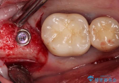 【インプラント】 他院で入れた被せ物が取れたの治療中