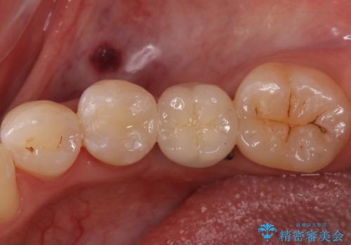 銀の詰め物 セラミックへのやり替えの治療後
