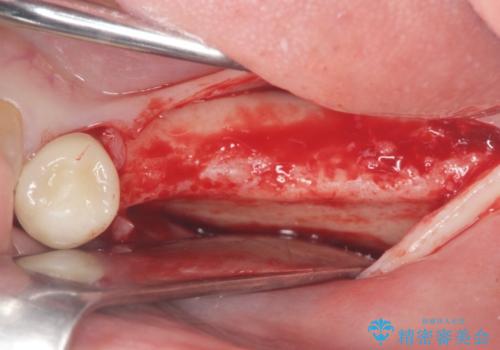 臼歯部の欠損　インプラント補綴の治療中