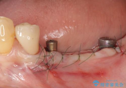 臼歯部の欠損 インプラント補綴の治療中