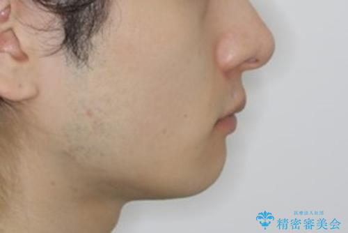 インビザライン:前歯のがたつきと噛み合わせの治療の治療後(顔貌)