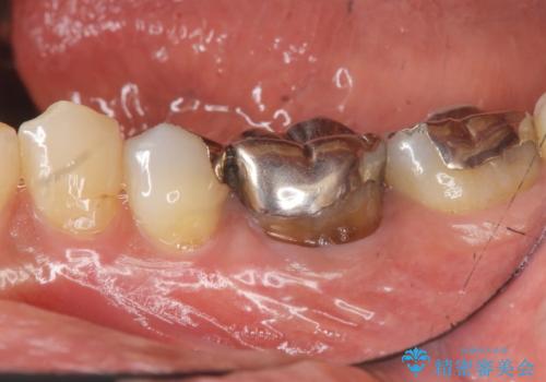 目立つ銀歯を白くしたいの症例 治療前