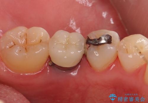 銀の詰め物 セラミックへのやり替えの治療前