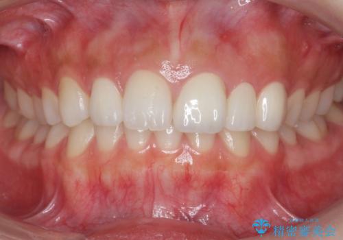 前歯が出っ歯ですきっ歯　抜かずに前歯を見た目良くの症例 治療後